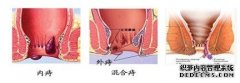武汉治疗痔疮多少钱
