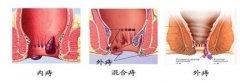 痔疮出血原因有哪些?