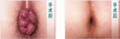外痔并发症状及治疗