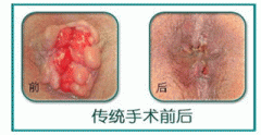 痔疮手术后遗症原因及处理方法