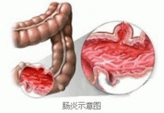 什么是直肠溃疡?