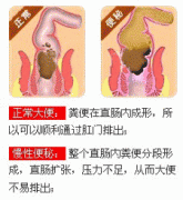 便秘肛门疼痛怎么回事?