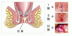 肛裂肛门痒怎么诊疗好?