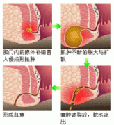 肛周脓肿肛瘘怎么治疗?