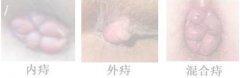 内痔、外痔、混合痔之间的区别