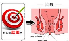 武汉治疗肛裂需要多少钱