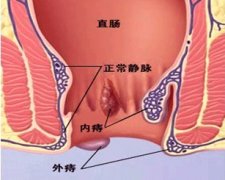便血鲜红怎么回事?